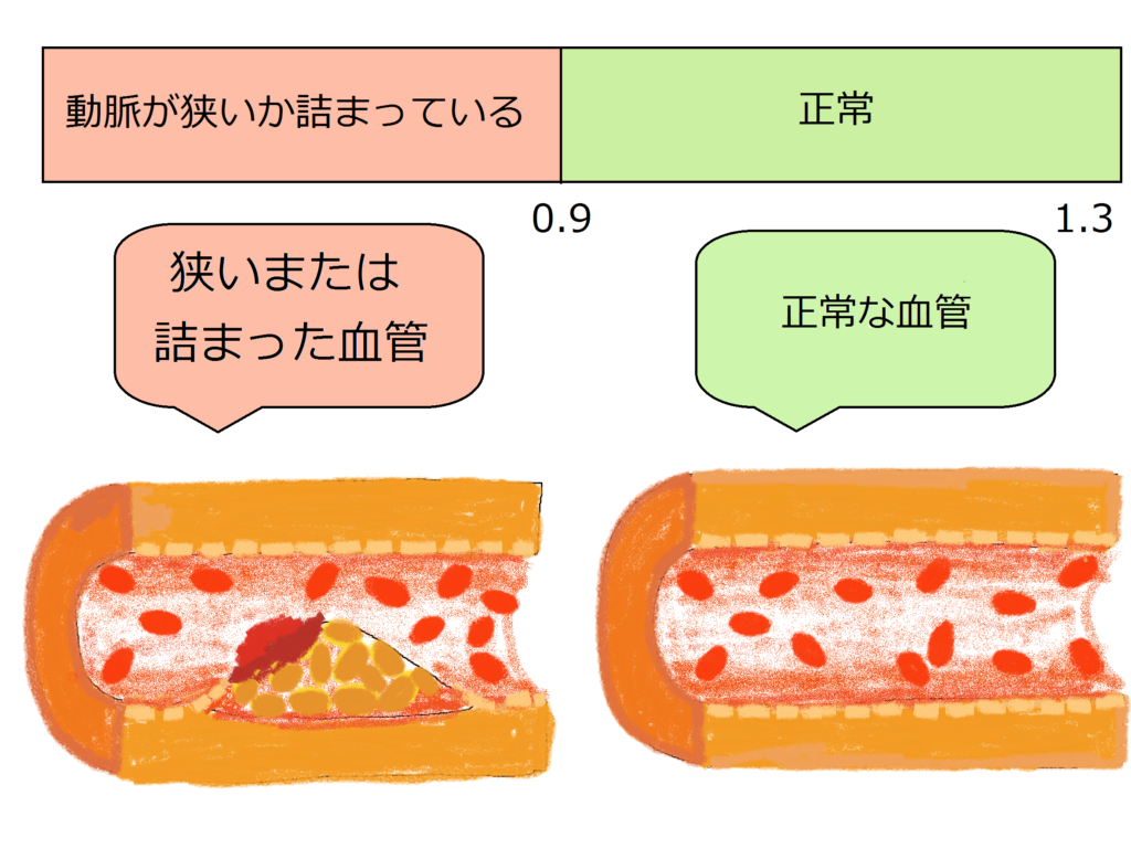 フットケア　下肢末梢動脈疾患