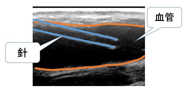 エコーガイド下穿刺