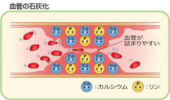 血管の石灰化